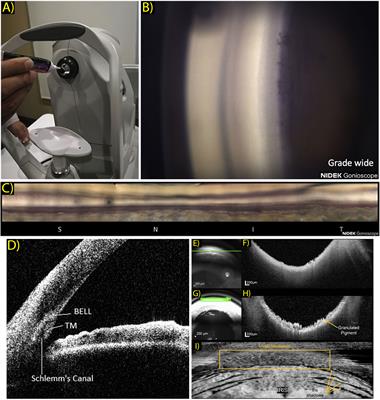 Advancements in high-resolution imaging of the iridocorneal angle